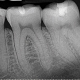 Dentalinė rentgeno nuotrauka